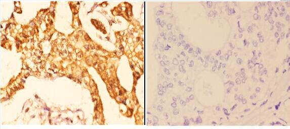 Immunohistochemistry (IHC) analyzes of 14-3-3 ζ (phospho-S58) pAb in paraffin-embedded human breast carcinoma tissue at 1:50,showing cytoplasmic and nuclear staining