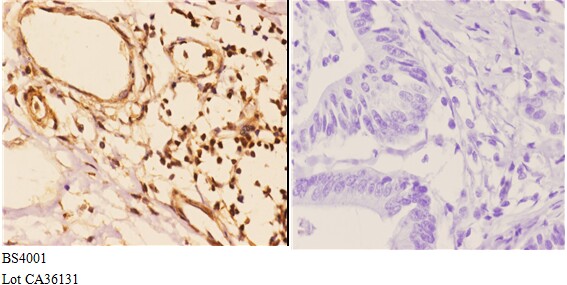 Immunohistochemistry (IHC) analyzes of 14-3-3 ζ (phospho-S58) pAb in paraffin-embedded human colon carcinoma tissue at 1:50,showing cytoplasmic and nuclear staining