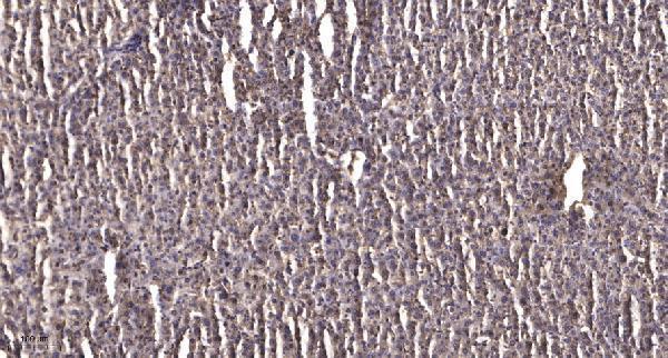 Immunohistochemical analysis of paraffin-embedded human liver cancer