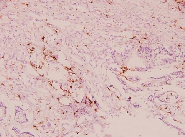 Immunohistochemistry (IHC) analyzes of IL-1α (F8) pAb in paraffin-embedded human breast carcinoma tissue at 1:100