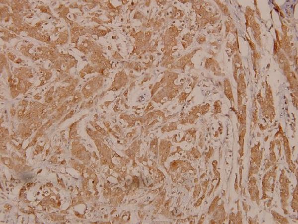 Immunohistochemistry (IHC) analyzes of p-PDPK1 (S241) pAb in paraffin-embedded human breast carcinoma tissue at 1:100