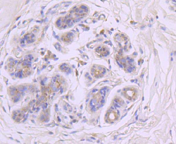 Immunohistochemical analysis of paraffin-embedded human breast carcinoma tissue using anti-GBA antibody