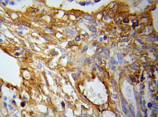 Immunohistochemistry (IHC) analysis of PKM2 pAb in paraffin-embedded Lung cancer tissue