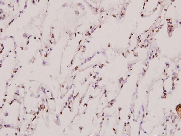 Immunohistochemistry (IHC) analyzes of THRB (L37) pAb in paraffin-embedded human lung carcinoma tissue at 1:100