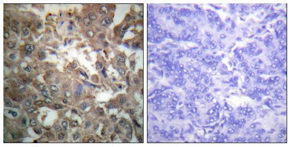 Immunohistochemistry analysis of paraffin-embedded human breast carcinoma tissue, using XPA Antibody