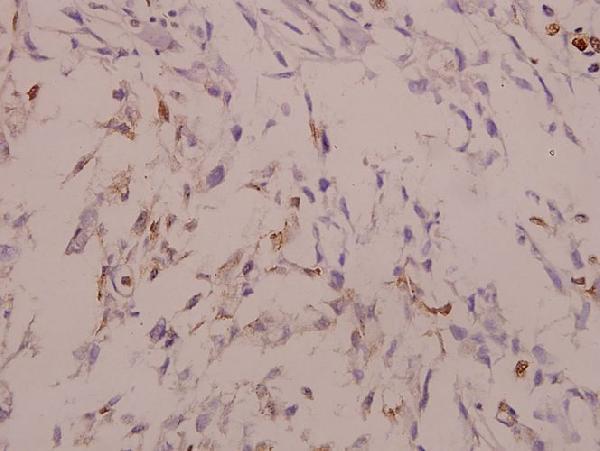 Immunohistochemistry (IHC) analyzes of MAPKAPK-2 (N218) pAb in paraffin-embedded human colorectal carcinoma tissue at 1:50