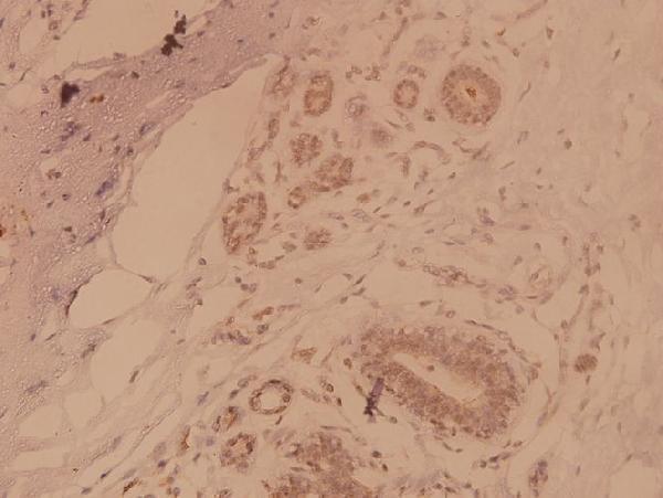 Immunohistochemistry (IHC) analyzes of MAPKAPK-2 (S328) pAb in paraffin-embedded human breast carcinoma tissue at 1:100
