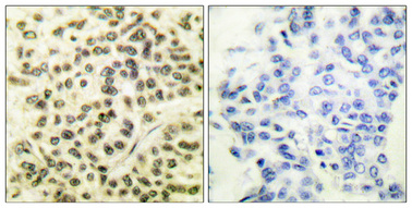 Immunohistochemical analysis of paraffin-embedded Human breast cancer