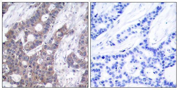 Immunohistochemistry analysis of paraffin-embedded human breast carcinoma, using Stathmin 1 (Phospho-Ser15) Antibody