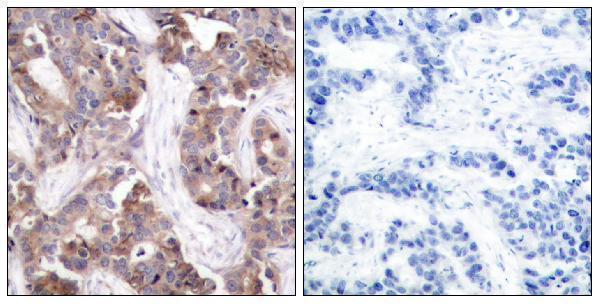 Immunohistochemistry analysis of paraffin-embedded human breast carcinoma, using Stathmin 1 (Phospho-Ser24) Antibody