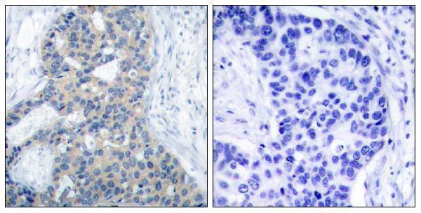 Immunohistochemistry analysis of paraffin-embedded human breast carcinoma, using Stathmin 1 (Phospho-Ser37) Antibody