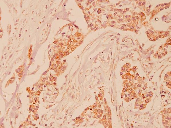 Immunohistochemistry (IHC) analyzes of FHIT (E116) pAb in paraffin-embedded human breast carcinoma tissue at 1:100
