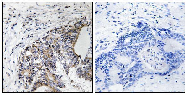 Immunohistochemistry analysis of paraffin-embedded human colon carcinoma, using FHIT (Phospho-Tyr114) Antibody