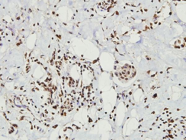 Immunohistochemistry (IHC) analyzes of CD9 (Y129) pAb in paraffin-embedded human breast carcinoma tissue at 1:100
