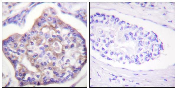 Immunohistochemistry analysis of paraffin-embedded human breast carcinoma, using Vinculin (Phospho-Tyr821) Antibody