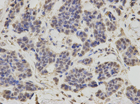 Immunohistochemistry of paraffin-embedded human liver cancer using RING1B/RNF2 Rabbit pAb  at dilution of 1:50 