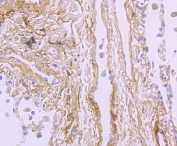 Immunohistochemical analysis of paraffin-embedded human lung cancer tissue using anti-TGFBI antibody