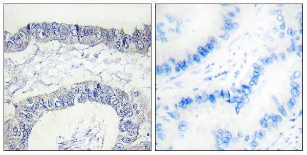 Immunohistochemistryt analysis of paraffin-embedded human lung carcinoma, using FA12 (heavy chain, Cleaved-Ile20) Antibody