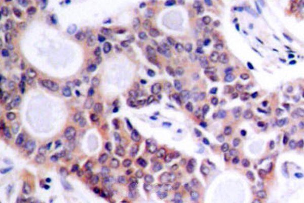 Immunohistochemistry (IHC) analyzes of NFkB-p100 (S869) pAb in paraffin-embedded human breast carcinoma tissue