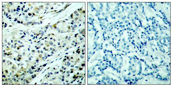 Immunohistochemistry analysis of paraffin-embedded human breast carcinoma, using HDAC5 (Phospho-Ser498) Antibody