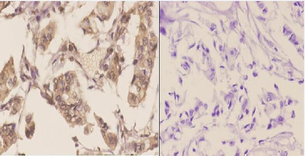 Immunohistochemistry (IHC) analyzes of Tsg 101 (E303) pAb in paraffin-embedded human breast carcinoma tissue at 1:50