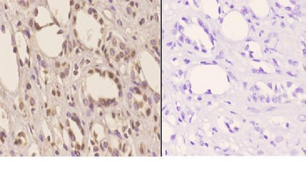 Immunohistochemistry (IHC) analyzes of Tsg 101 (E303) pAb in paraffin-embedded human kidney carcinoma tissue at 1:50