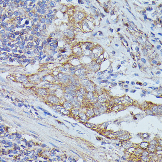 Immunohistochemistry of paraffin-embedded human lung cancer using Cortactin antibody at dilution of 1:100 (40x lens)