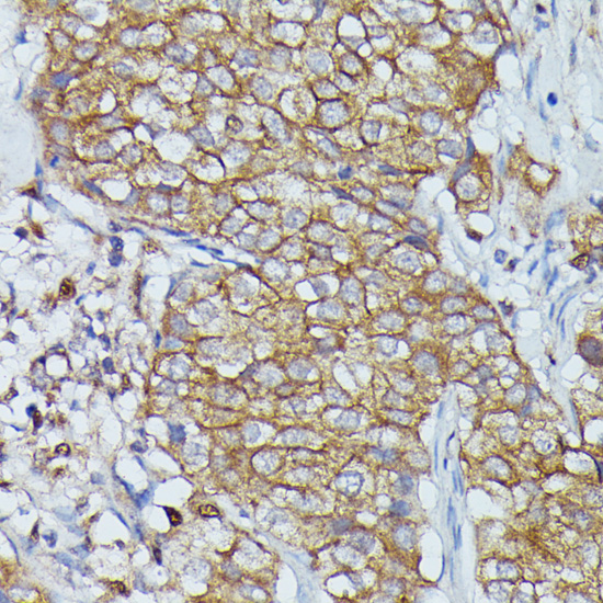 Immunohistochemistry of paraffin-embedded human mammary cancer using Cortactin antibody (A15054) at dilution of 1:100 (40x lens)