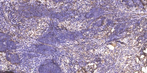 Immunohistochemical analysis of paraffin-embedded human cervical carcinoma