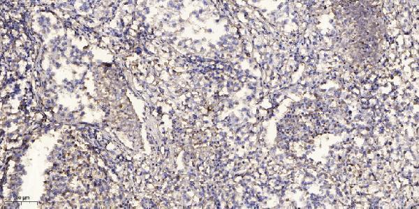 Immunohistochemical analysis of paraffin-embedded human Squamous cell carcinoma of lung