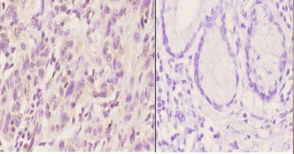 Immunohistochemistry (IHC) analyzes of Ku-86 (S462) pAb in paraffin-embedded human esophageal carcinoma tissue at 1:50