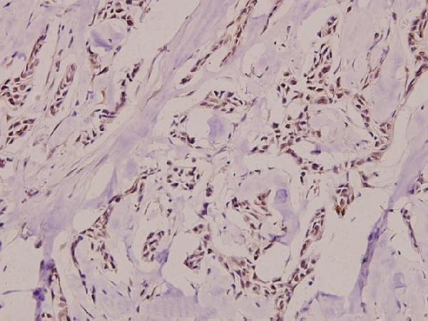 Immunohistochemistry (IHC) analyzes of p-Ku-80 (T714) pAb in paraffin-embedded human breast carcinoma tissue at 1:100