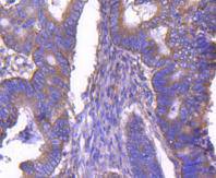 Immunohistochemical analysis of paraffin-embedded human colon cancer tissue using anti-ARF1 antibody