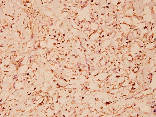 Immunohistochemistry (IHC) analyzes of HSP60 (T547) pAb in paraffin-embedded human breast carcinoma tissue at 1:100