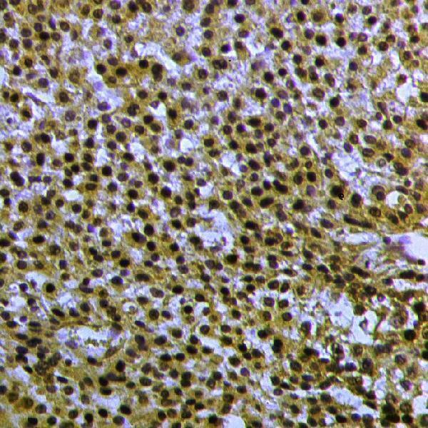 Immunohistochemistry (IHC) analyzes of RXRA (phospho-S260) polyclonal antibody in paraffin-embedded human liver cancer tissue at 1:50