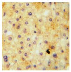 Immunohistochemical analysis of ELN staining in human liver cancer formalin fixed paraffin embedded tissue section