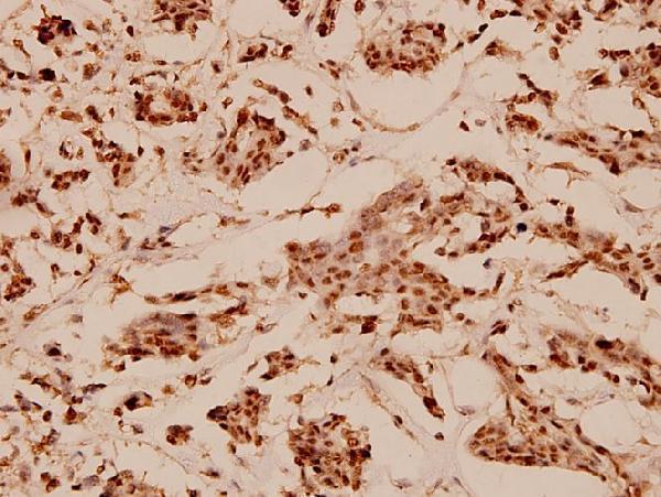 Immunohistochemistry (IHC) analyzes of N-CoR (H76) pAb in paraffin-embedded human breast carcinoma tissue at 1:100