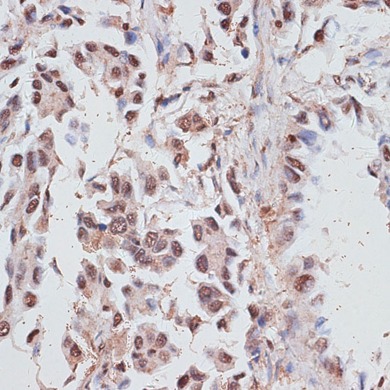 Immunohistochemistry of paraffin-embedded human lung cancer using RPA70/RPA70/RPA1 antibody  at dilution of 1:100 