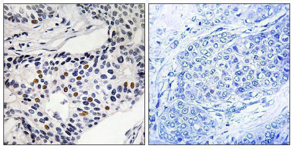Immunohistochemistry analysis of paraffin-embedded human breast carcinoma, using WEE1 (Phospho-Ser53) Antibody