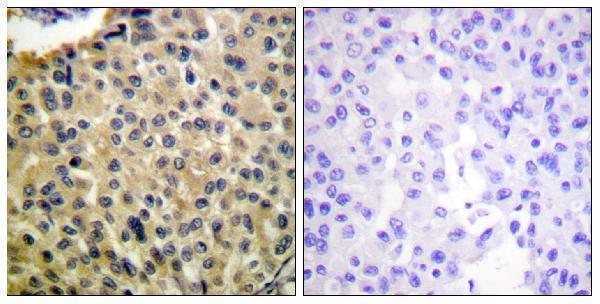 Immunohistochemistry analysis of paraffin-embedded human breast carcinoma, using KIT (Phospho-Tyr703) Antibody