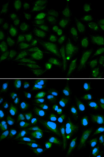 Immunohistochemistry of paraffin-embedded human breast cancer using Decorin Rabbit pAb  at dilution of 1:50 