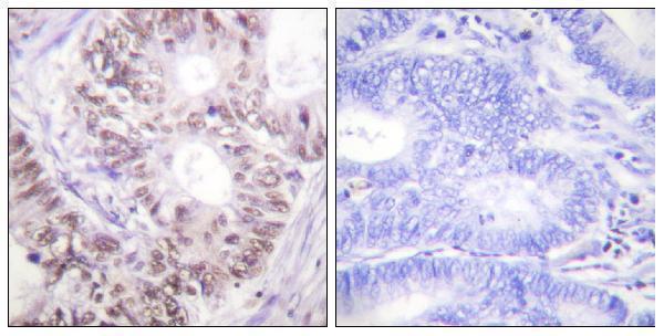Immunohistochemistry analysis of paraffin-embedded human colon carcinoma, using CDC25C (Phospho-Thr48) Antibody