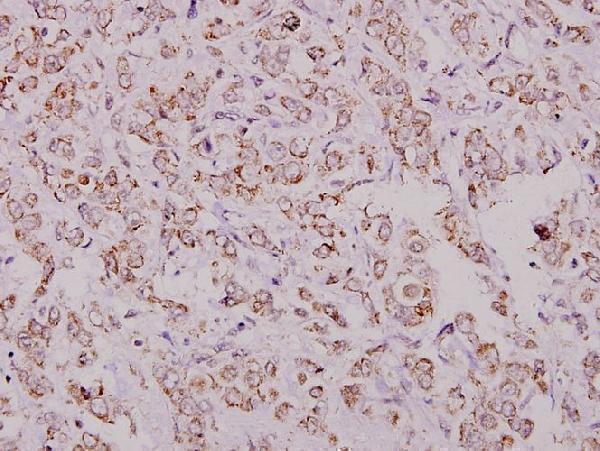 Immunohistochemistry (IHC) analyzes of eIF4G (Q1103) pAb in paraffin-embedded human breast carcinoma tissue at 1:100