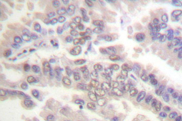 Immunohistochemistry (IHC) analysis of p-Cdc6 (S54) pAb in paraffin-embedded human lung carcinoma tissue