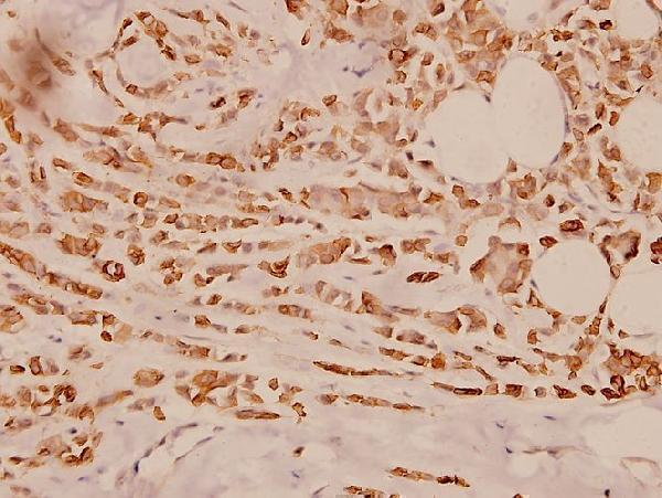 Immunohistochemistry (IHC) analyzes of Cytokeratin 18 (S48) pAb in paraffin-embedded human breast carcinoma tissue at 1:100