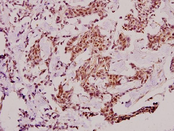 Immunohistochemistry (IHC) analyzes of Stat2 (L684) pAb in paraffin-embedded human breast carcinoma tissue at 1:100