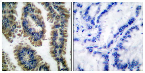 Immunohistochemistry analysis of paraffin-embedded human lung carcinoma, using STAT2 (Phospho-Tyr690) Antibody