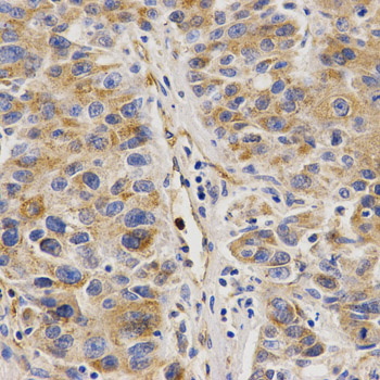 Immunohistochemistry of paraffin-embedded human colon carcinoma using VAPB Rabbit pAb  at dilution of 1:50 