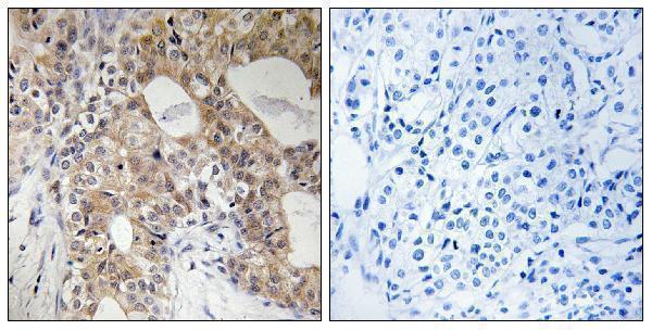 Immunohistochemistry analysis of paraffin-embedded human breast carcinoma, using SPHK2 (Phospho-Thr614) Antibody