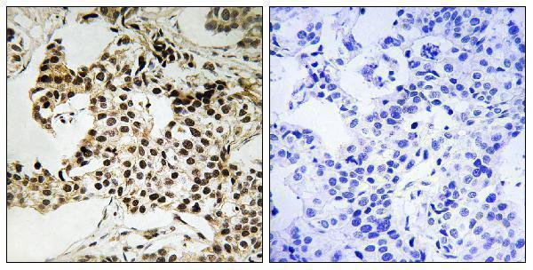 Immunohistochemistry analysis of paraffin-embedded human breast carcinoma, using PKR (Phospho-Thr258) Antibody
